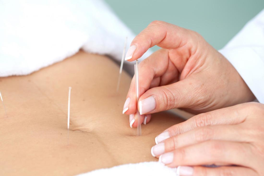 Doctor applying acupuncture pain relief method